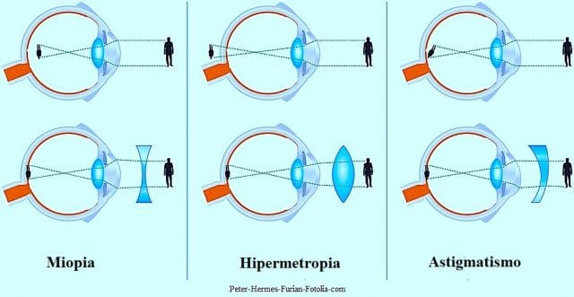 Hipermetropia astigmatismo e miopia
