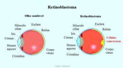 Retinoblastoma no olho