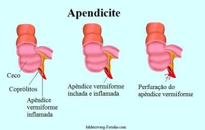 Sintomas da apendicite