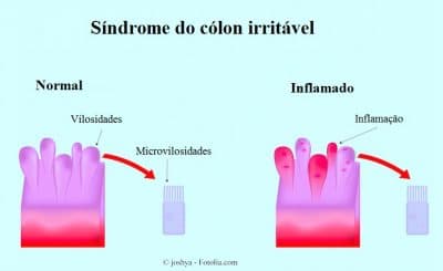 Síndrome do cólon irritável