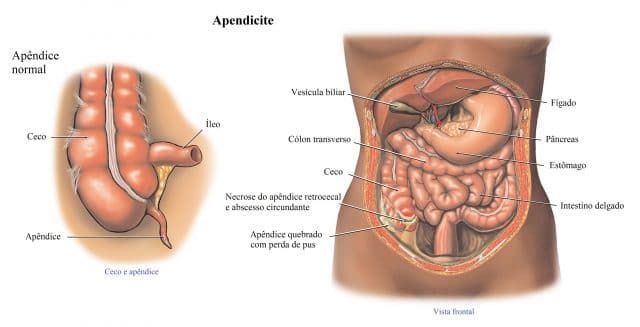 apendicite,infecção,apêndice