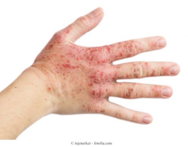 dermatite de contato,mão