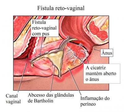 fístula,anal,reto,vaginal