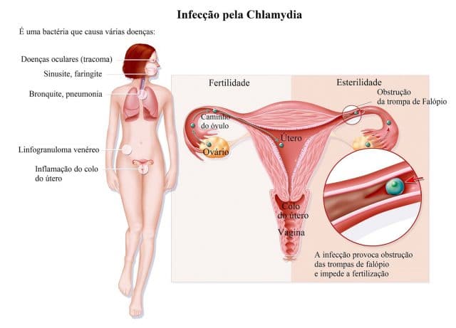 infertilidade,clamídia