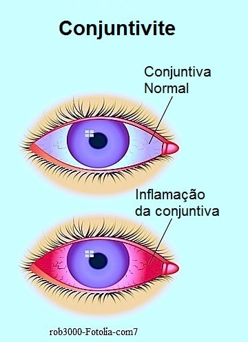 Conjuntivite viral,bacteriana,olhos vermelhos