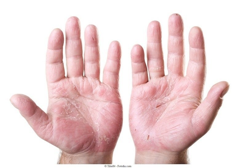Mãos,dermatite, contato