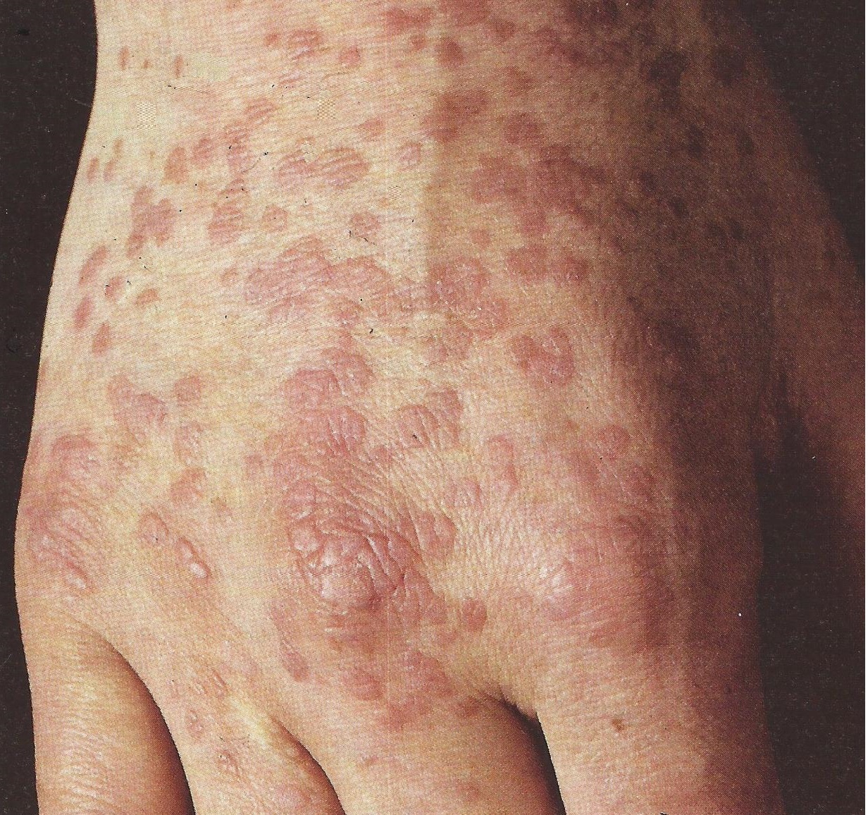 warts on hands meaning analize pt anemie
