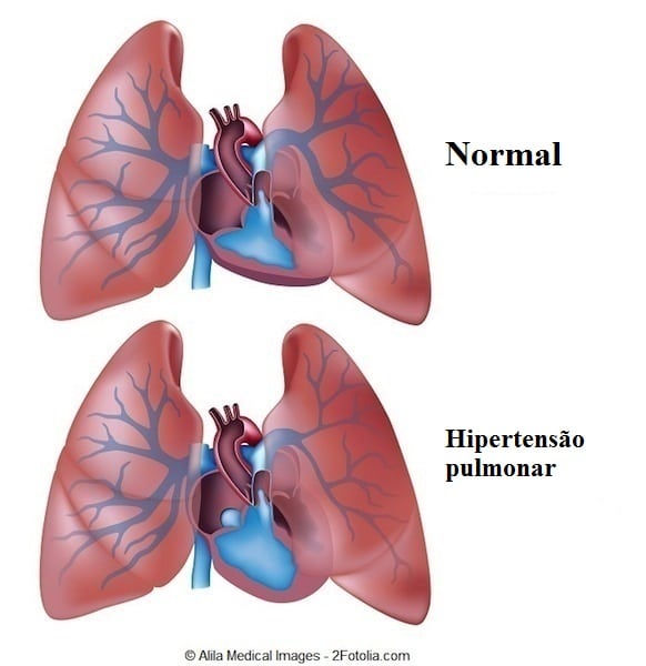 Hipertensão,pulmão,pulmonar