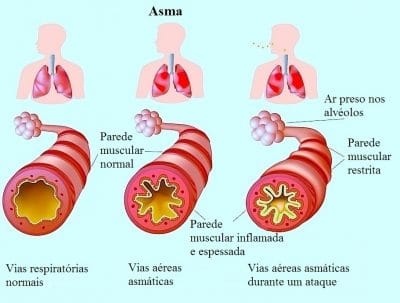 Asma brônquica