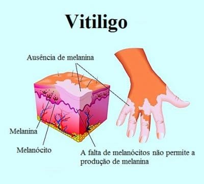 tratamento para Vitiligo
