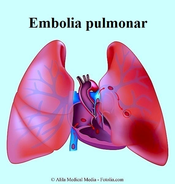 Embolia pulmonar, pulmões, brônquios