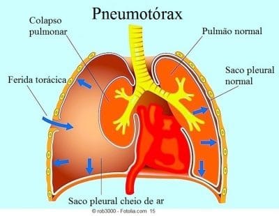 Pneumotórax espontâneo ou traumático