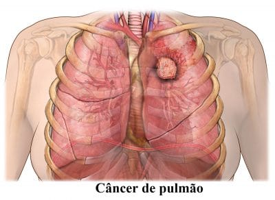 câncer,de,pulmão