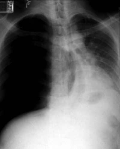 pneumotórax hipertensivo,pulmão colapsado compressão cardíaca,mediastino
