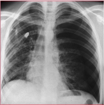 radiografia,pneumotórax esquerdo, traquéia, coração, à direita