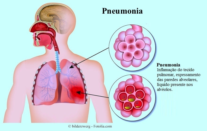 sintomas da pneumonia