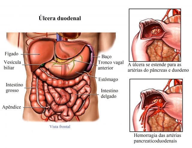 úlcera,duodenal,e,gástrico