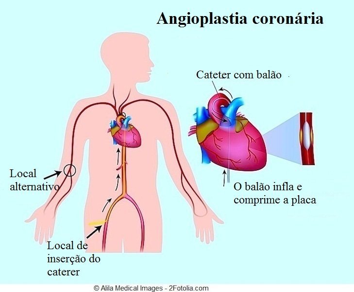 Angioplastia coronária