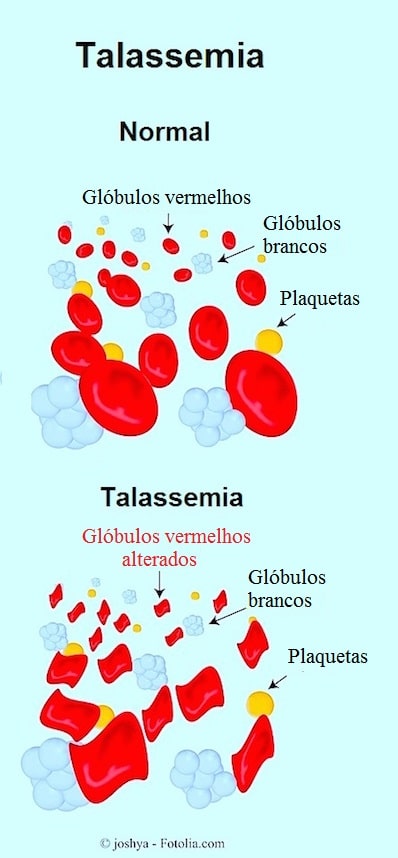 Anemia mediterrânea ou talassemia