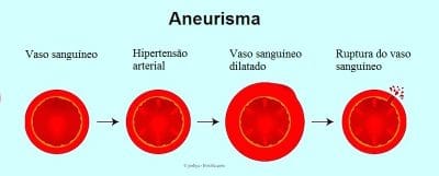 Aneurisma da aorta