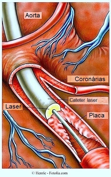 Angioplastia coronária