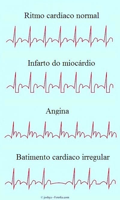 Arritmia cardíaca
