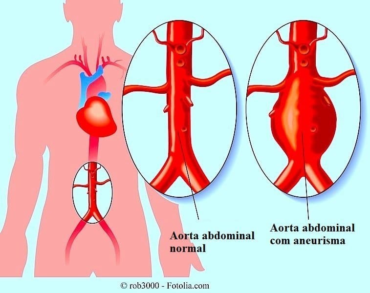  Aneurisma da aorta