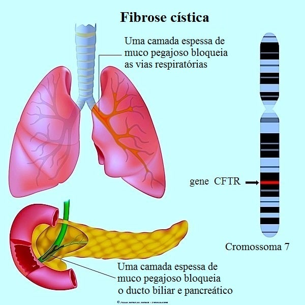 Fibrose cística, muco, gene, pancreas, pulmao