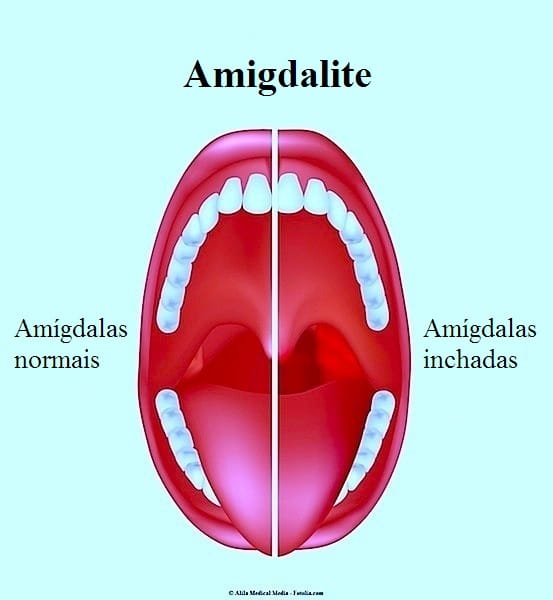 amigdalite 
