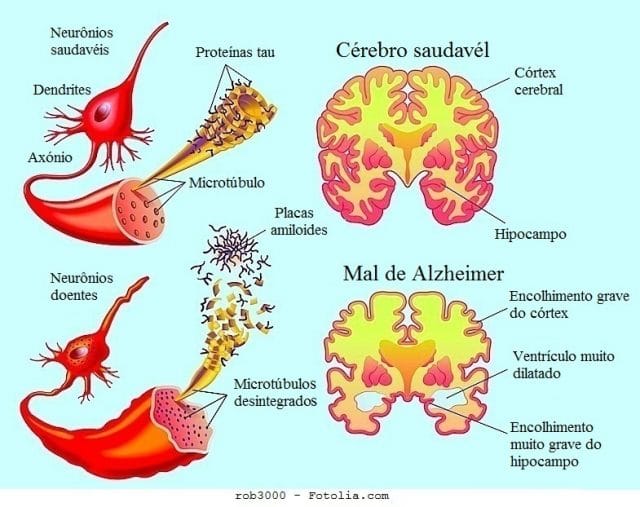 Mal de Alzheimer