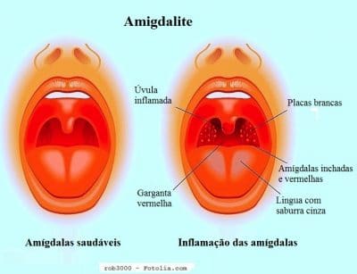 Sintomas da amigdalite e remédios