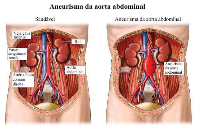 aneurisma,da,aorta