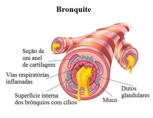 bronquite,muco,vias respiratorias,inflamação