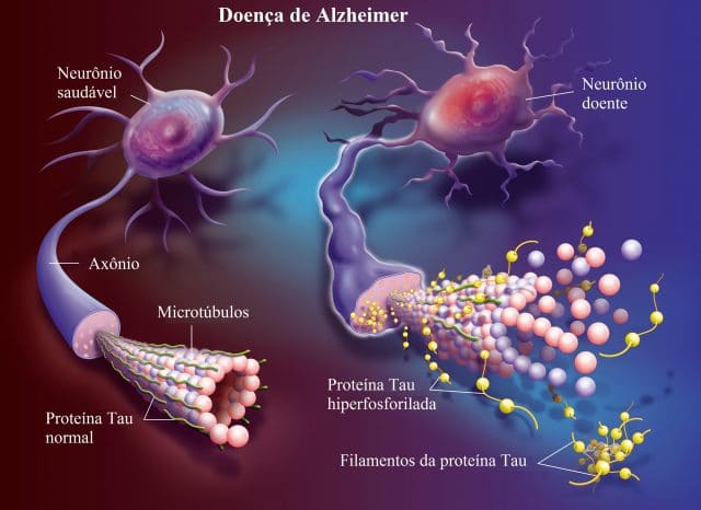 doença,de,Alzheimer