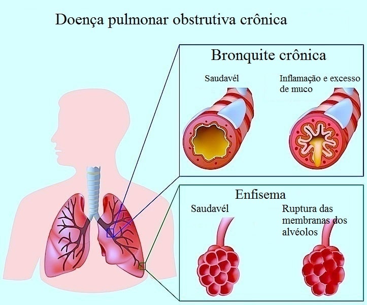 Doença pulmonar obstrutiva crônica,bronquite,alvéolos