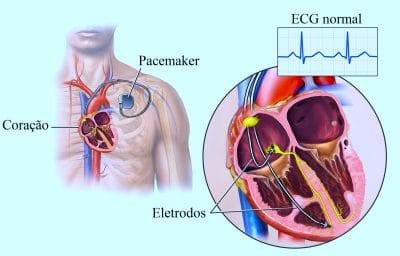 pacemaker