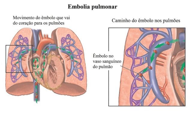 embolia,pulmonar