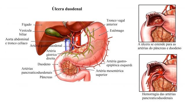 úlcera,duodenal,anatomia,estômago