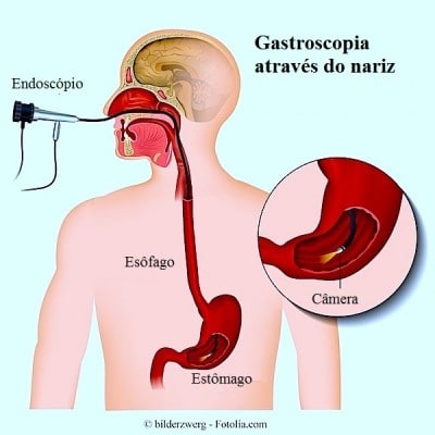 Gastroscopia no estômago