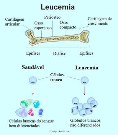 Leucemia linfocítica
