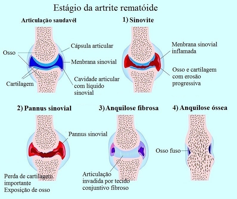 Sintomas da artrite reumatóide