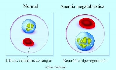 anemia,globulos,neutrofilos