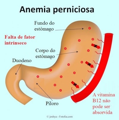 Anemia perniciosa