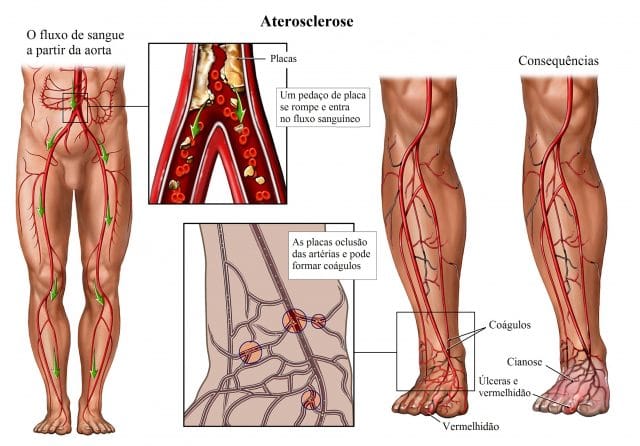 arteriosclerose,aterosclerose-placas,artérias,cianose,úlceras