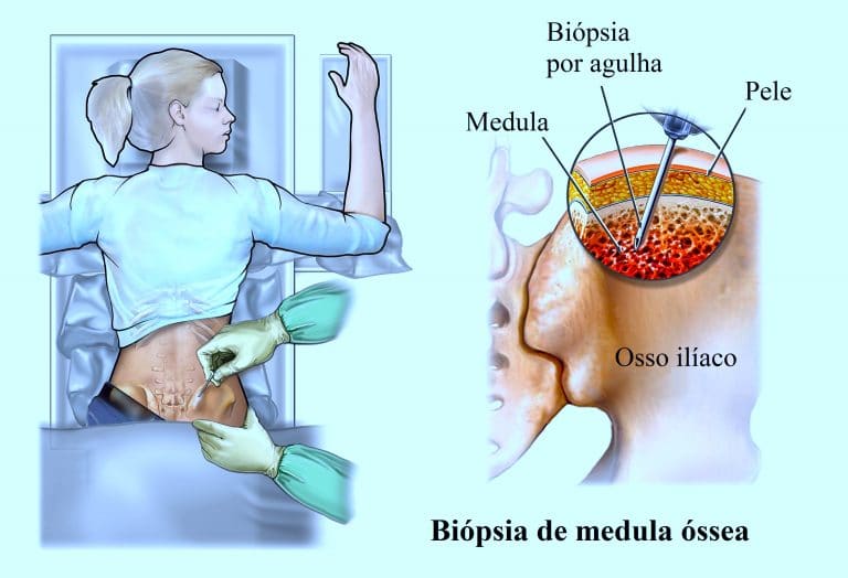 Biopsia estómago efectos secundarios