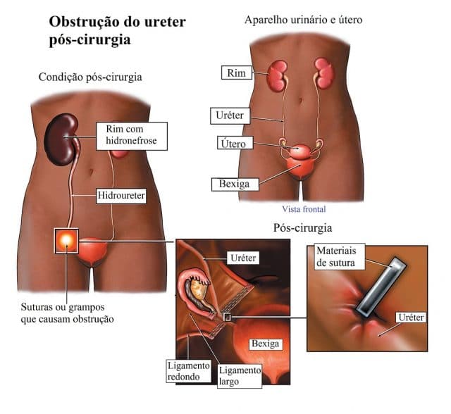 estenose,uretral,obstrução,hydronephrosis