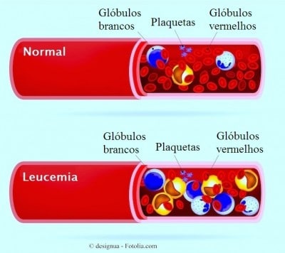 leucemia mielóide