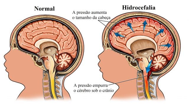 hidrocefalia,espinha,bífida
