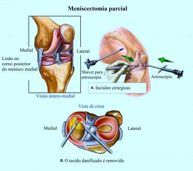 artroscopia,joelho,meniscectomia