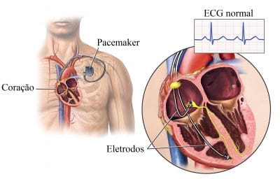pacemaker,estimulador,elétrico